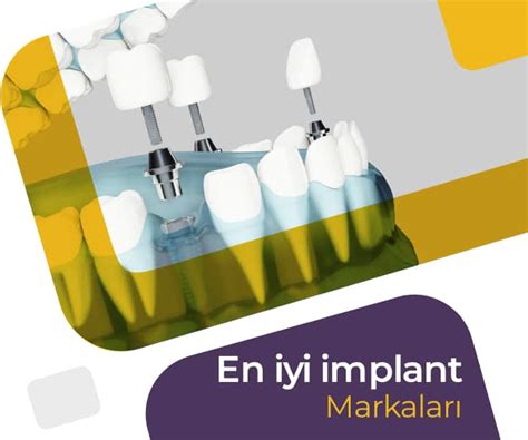 En İyi Diş İmplant Markaları .